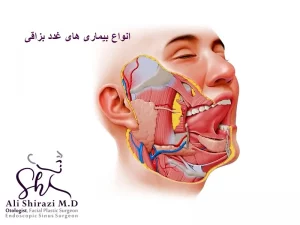 انواع بیمار یهای غدد بزاقی