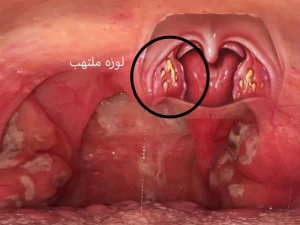 لوزه سوم