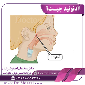 آدنوئید چیست؟