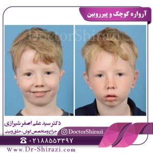 آرواره کوچک در کودکان