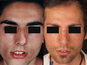 نمونه عمل بینی کج و پیچ خورده توسط دکتر شیرازی