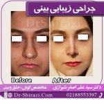 جراحی زیبایی بینی