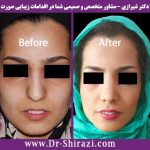 جراحی بینی گوشتی با مدل طبیعی دکتر علی شیرازی