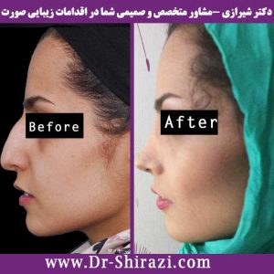 جراحی بینی عقابی زنان توسط دکتر شیرازی