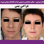 جراحی بینی در خانم جوان با نوک گوشتی