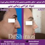 جراحی بینی خانم مسن و رفع ایراد بینی بعد از عمل