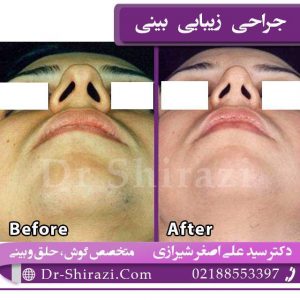 عمل زیبایی بینی