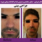 جراحی بینی با نوک بسیار گوشتی دکتر شیرازی