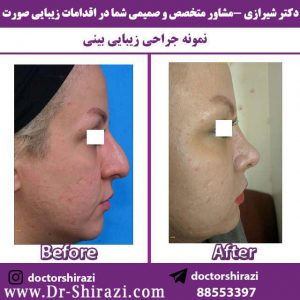 جراحی افتادگی بینی عقابی