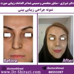 جراحی زیبایی بینی کج و افتاده قبل و بعد عمل