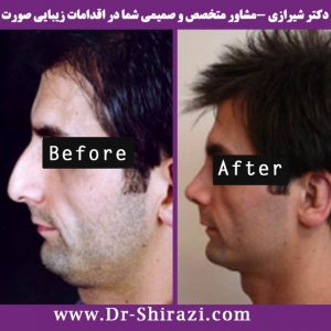 جراحی بینی استخوانی مردانه توسط دکتر شیرازی