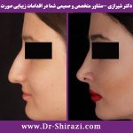 جراحی زیبایی بینی مدل طبیعی کار دکتر شیرازی