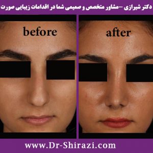 نمونه قبل و بعد از جراحی زیبایی بینی گوشتی خانم