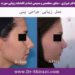 قبل و بعد از جراحی زیبایی در قسمت بینی