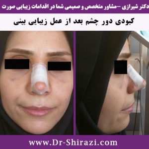 چسب بعد از عمل بینی و کبودی دور چشم