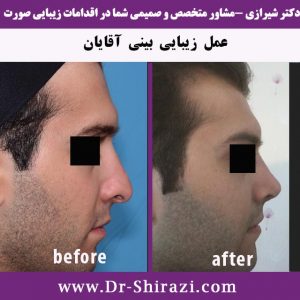 نمونه جراحی آقایان رینوپلاستی مردانه