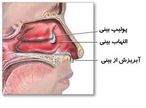 ساختمان بینی و پولیپ بینی