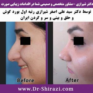 عکس از عمل بینی و تغییرات بینی بعد از عمل