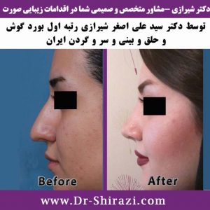 جراحی بینی با مدل طبیعی و زیبایی چهره بعد از عمل