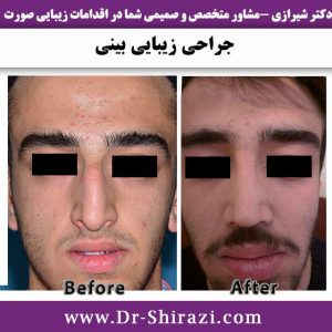 جراحی بینی عقابی آقایان از مقابل توسط دکتر شیرازی