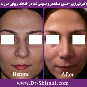 رینوپلاستی بینی با نوک گوشتی از رو به رو
