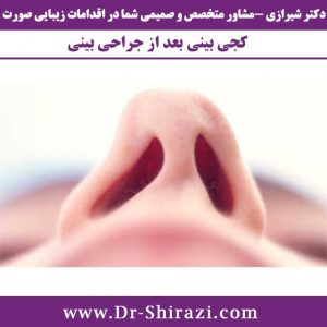 کج شدن بینی بعد از جراحی بینی