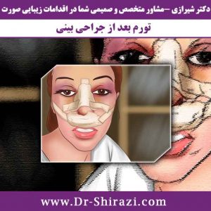 کبودی و تورم صورت بعد از جراحی بینی