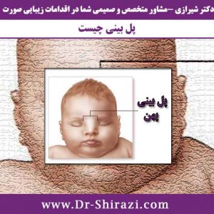 پهن بودن پل بینی
