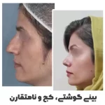 نمونه کار جراحی بینی