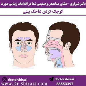 عکس شماتیک کوچک کردن شاخک بینی