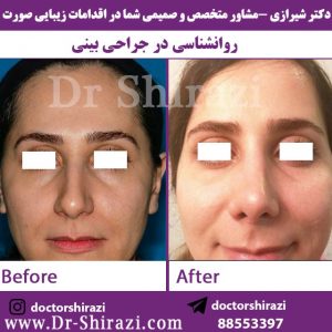 قبل و بعد جراحی بینی توسط دکتر شیرازی