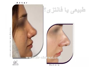 بینی طبیعی یا فانتزی؟