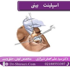 اسپلینت بینی