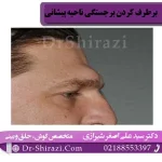 برجستگی ناحیه پیشانی