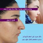 جراحی افتادگی بینی قوزدار دکتر شیرازی متخصص جراحی بینی