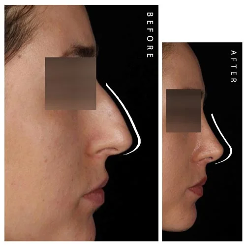 جراحی بینی استخوانی قبل و بعد