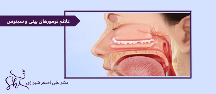 علائم تومورهای بینی و سینوس