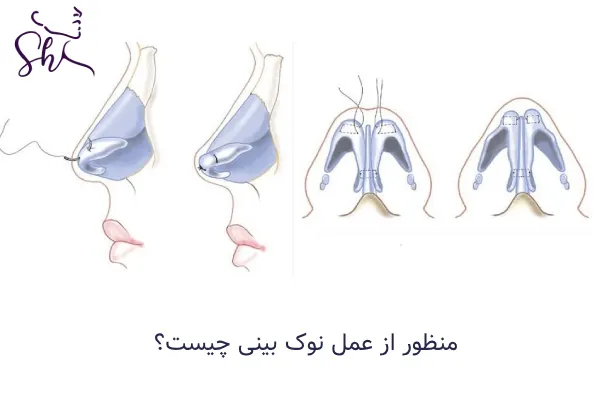 عمل نوک بینی چیست؟